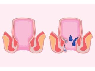 Experienced Piles Surgeon in Kolkata for Effective Treatment