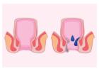 Experienced Piles Surgeon in Kolkata for Effective Treatment
