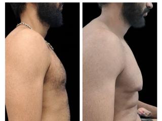 Gynecomastia Treatment in Baner - The Aesthetic Hub