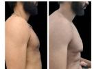 Gynecomastia Treatment in Baner - The Aesthetic Hub