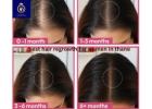 Best Hair Growth Treatment for Women in Thane | DNA Royal.