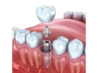 Your Trusted Dentist for Dental Implants & Complete Family Dentistry