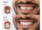 Natural-Looking Dental Crowns in Vile Parle West, Mumbai: AK Dental Clinic