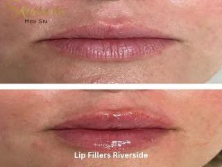 Lip Fillers Riverside for Personalized Lip Enhancement