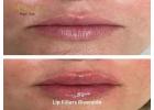 Lip Fillers Riverside for Personalized Lip Enhancement