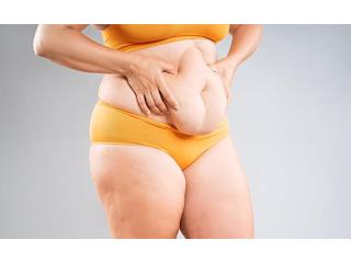 Tummy Tuck Surgery in Delhi - Dr Rajat Gupta