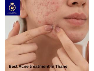 Trusted Acne Treatment Clinic in Thane – DNA Royal.