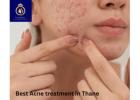 Trusted Acne Treatment Clinic in Thane – DNA Royal.