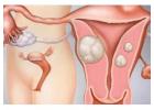 Explore Uterine Fibroid Embolization Treatment Options