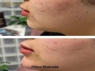 Fillers Riverside for a Refreshed and Natural Look