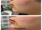 Fillers Riverside for a Refreshed and Natural Look