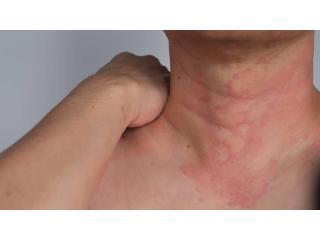 Chronic urticaria research