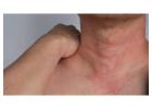 Chronic urticaria research