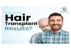 Hair Transplant Cost in Delhi | Price List & Boosted FUE – Dermalife