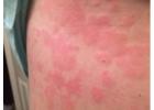 Mast Cell Activation Syndrome
