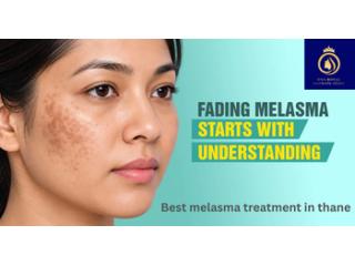Get Expert Melasma Treatment in Thane with DNA Royal.