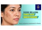 Get Expert Melasma Treatment in Thane with DNA Royal.