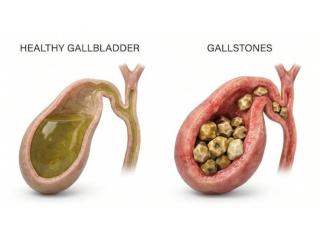 Best Surgeon for Gall Stone in Kolkata – Dr. Purnendu Roy