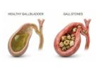 Best Surgeon for Gall Stone in Kolkata – Dr. Purnendu Roy