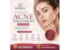 Acne Treatment in Indore - Aestheva 