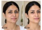 Best Laser Skin Tightening Treatments in Amritsar for Firm Skin