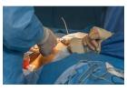 Breast Lump Surgery in Kolkata for Expert Medical Support