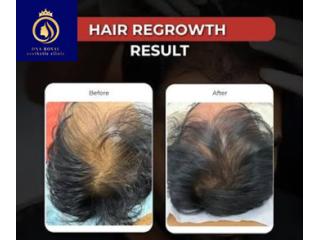 Top Hair Regrowth Solutions for Women in Thane | DNA Royal.