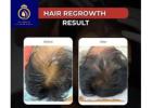 Top Hair Regrowth Solutions for Women in Thane | DNA Royal.